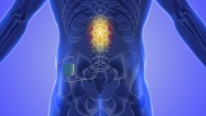 Spinal cord stimulator implant graphic.